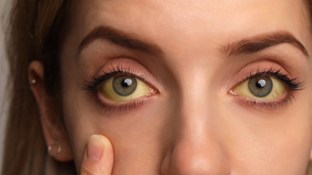Woman checking her health condition, closeup. Yellow eyes as symptom of problems with liver