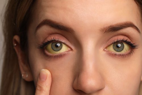 Woman checking her health condition, closeup. Yellow eyes as symptom of problems with liver