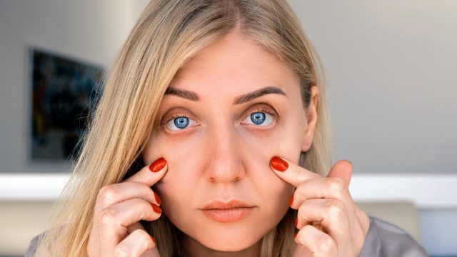 Ophthalmology, vision problems. Portrait of 30 year old blue eyed woman, pulling back skin under her eyes, looks at camera with frustrated look. Problems of aging and appearance. Optometrist, surgery