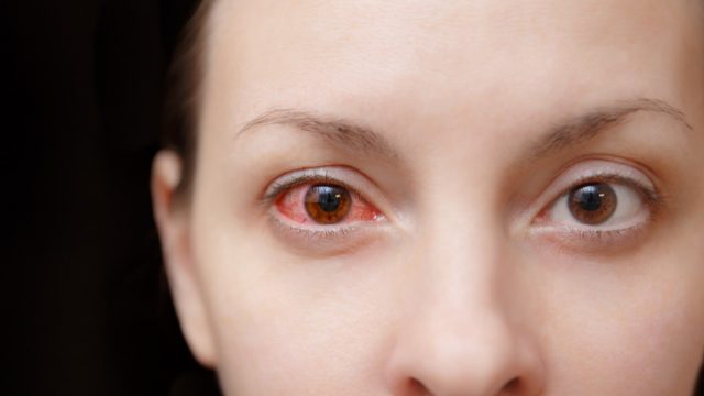 Close up one annoyed red blood human girl eye, health eye affected by conjunctivitis or after flu cold allergy. Looking camera. Disease treatment medicine health concept. Copy space. Workspace mockup.