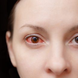 Close up one annoyed red blood human girl eye, health eye affected by conjunctivitis or after flu cold allergy. Looking camera. Disease treatment medicine health concept. Copy space. Workspace mockup.